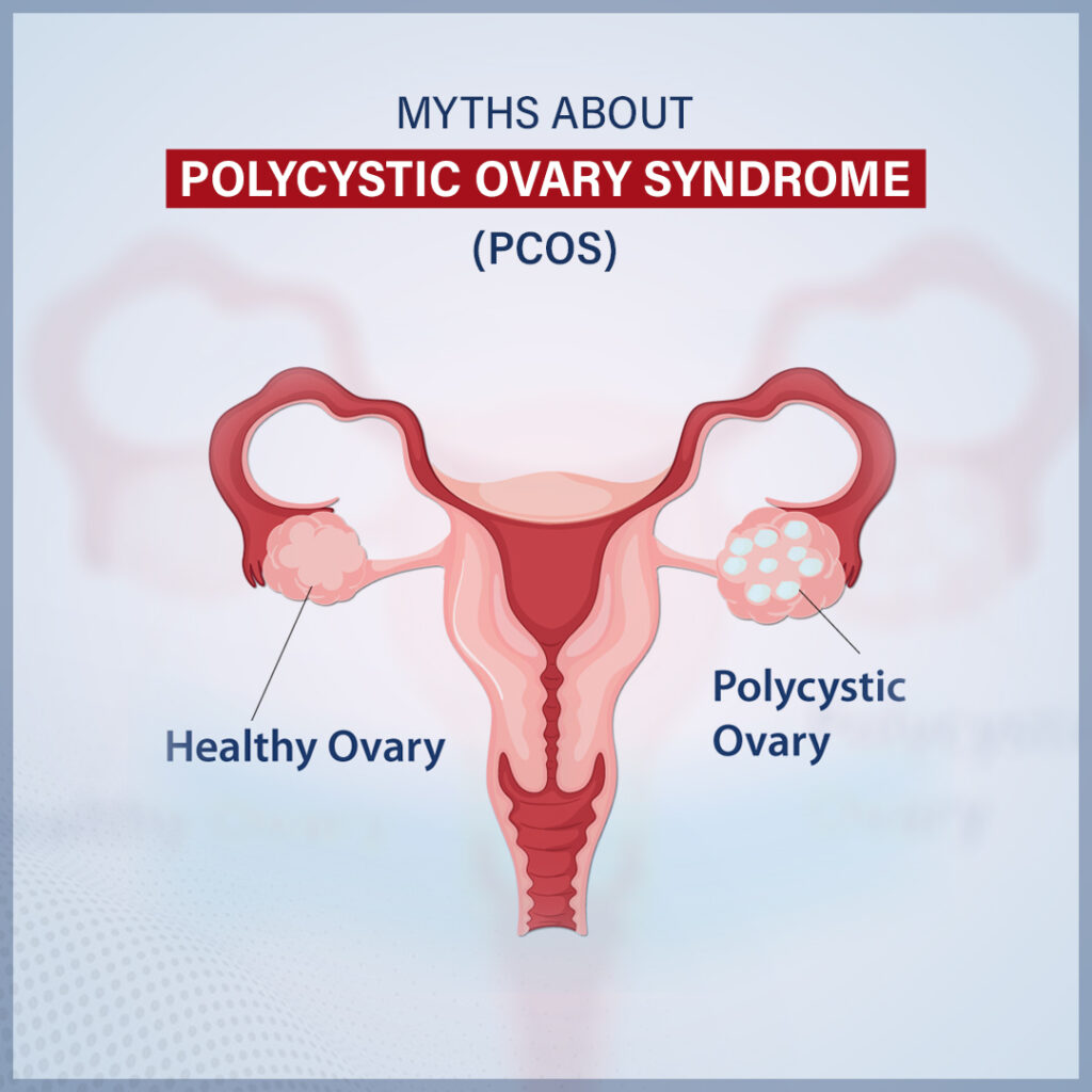 MYTHS ABOUT POLYCYSTIC OVARY SYNDROME (PCOS)