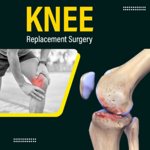 What Should You Expect From Knee Replacement Surgery?